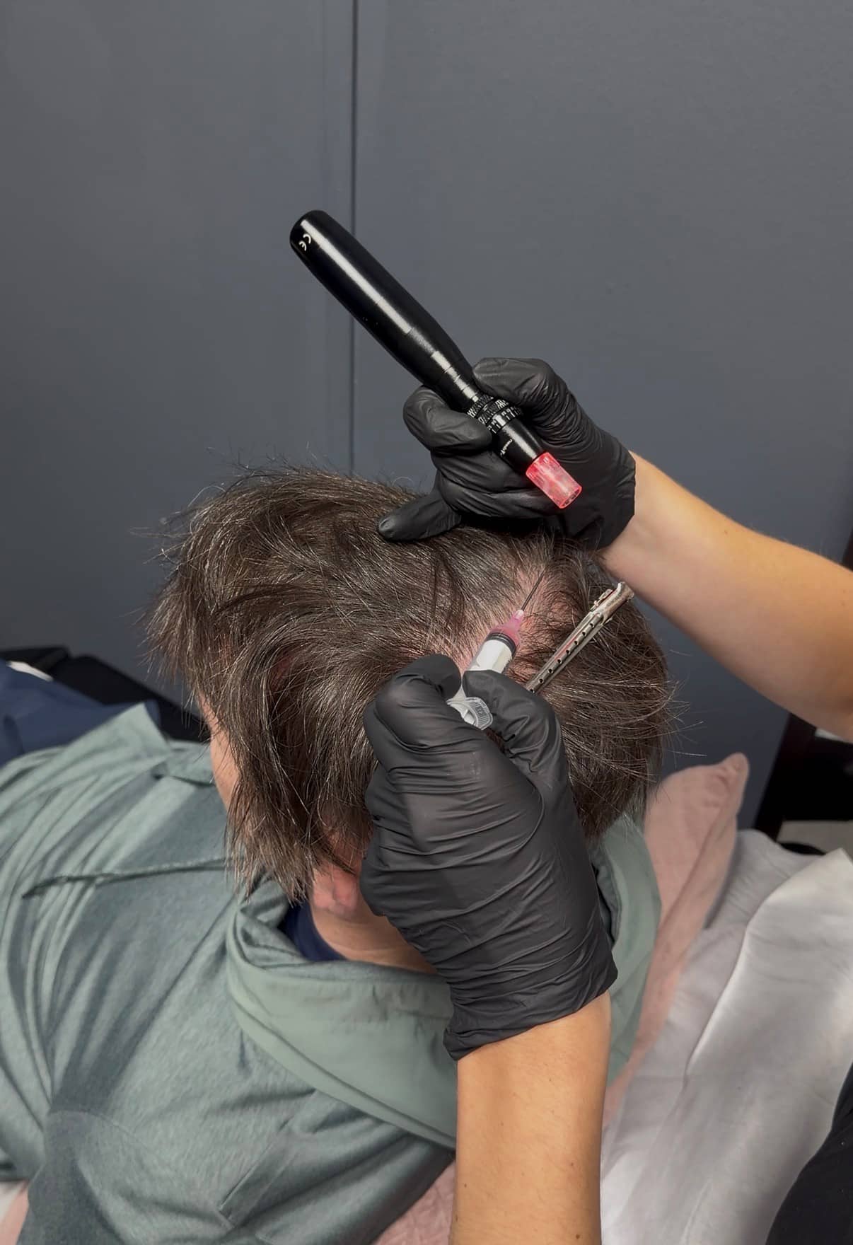 Medical Microneedling with Exosomes