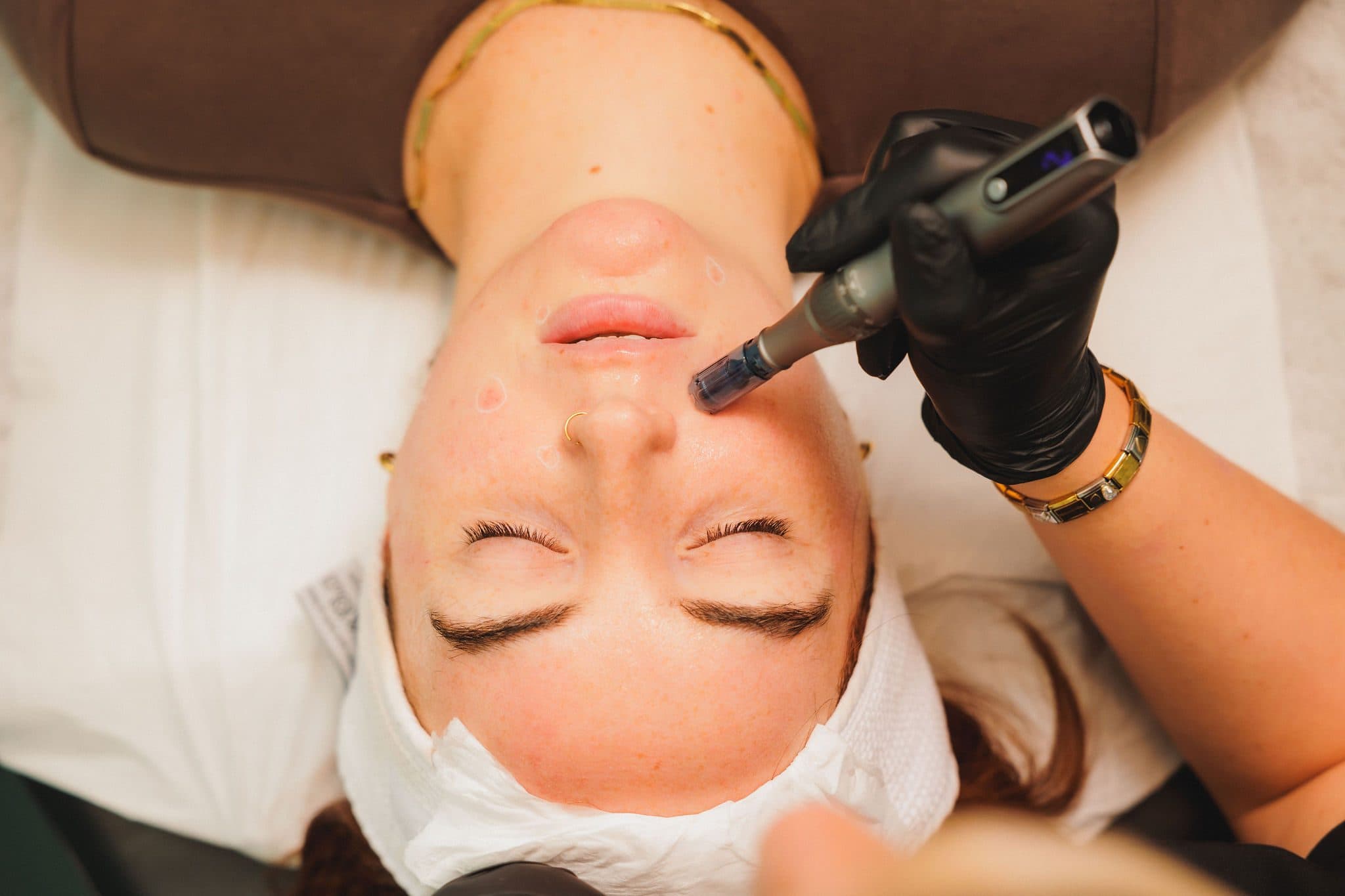 Microneedling Skin Treatment at Be-You Hair Clinic Dublin